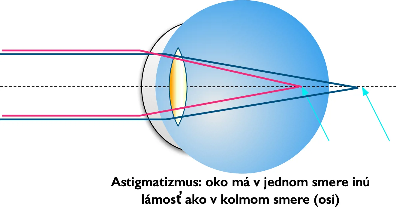 očný astigmatizmus: schéma oka