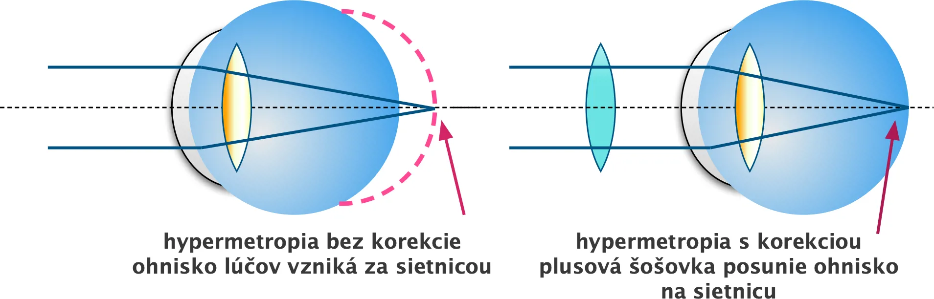 Schéma hypermetropie