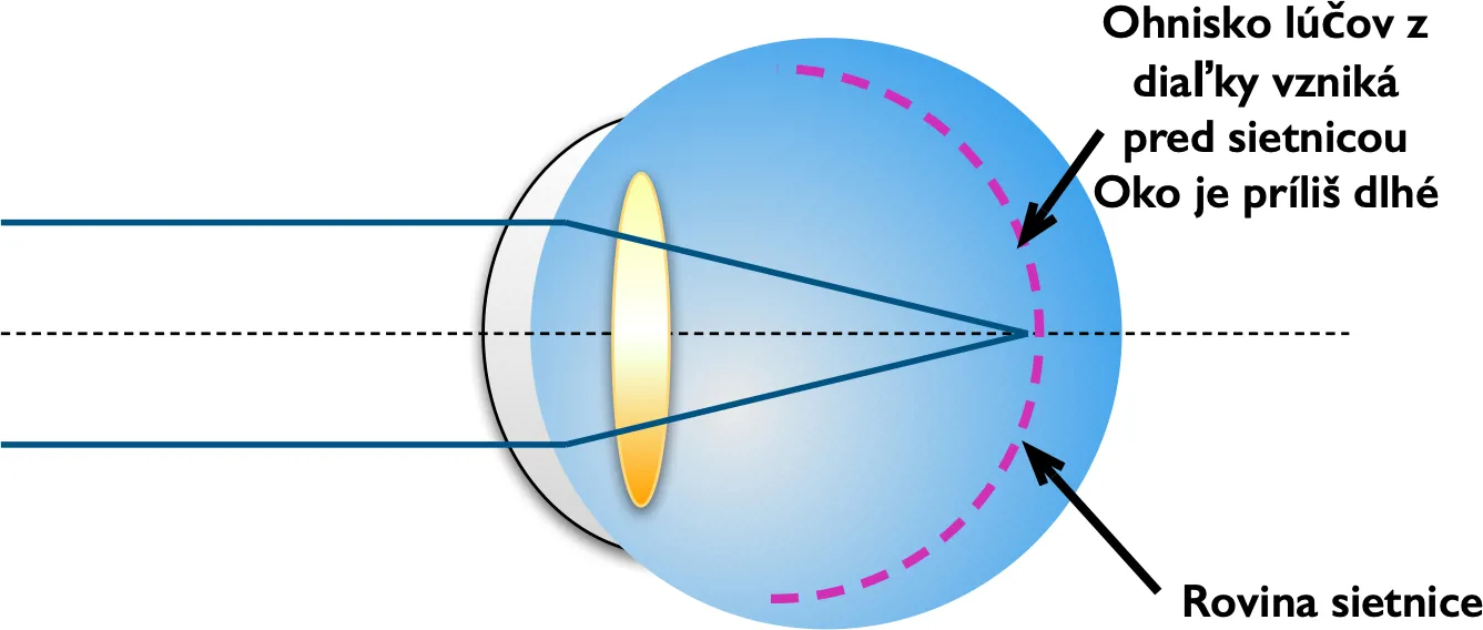 Schéma myopického oka