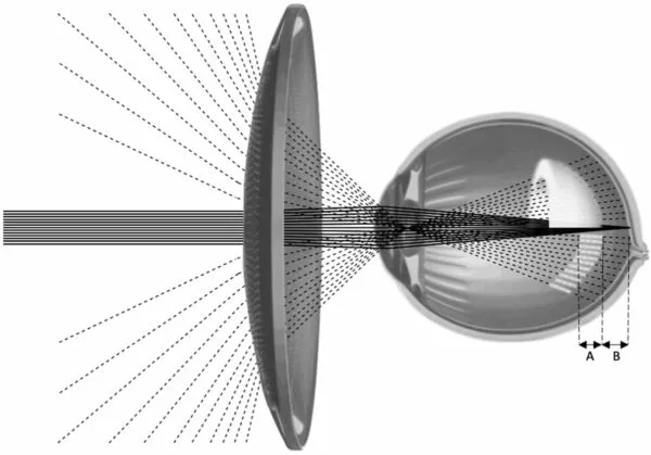 Stellest - optický princip okulirovej šošovky na spomalenie myopie