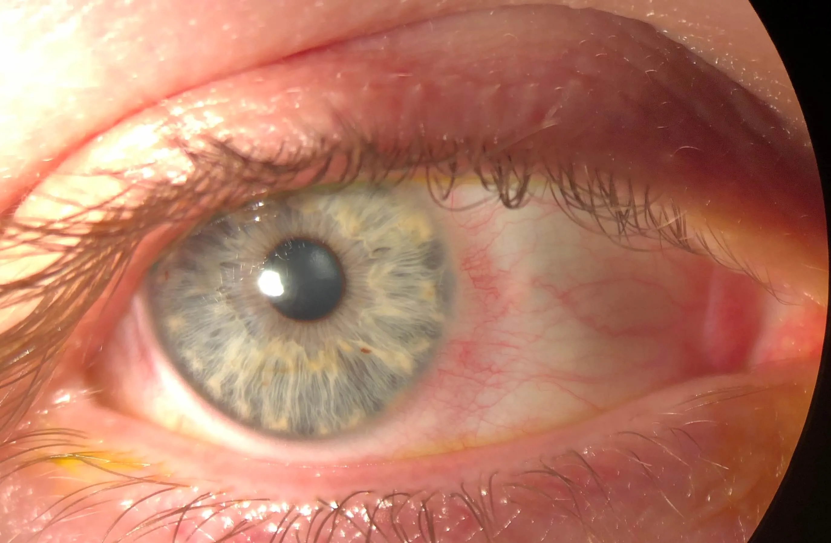 zarudnutie spojoviek ako jeden z príznakov očné infekcie koronavirem